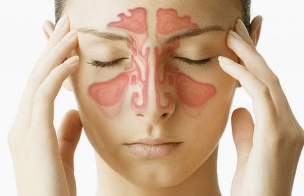 [General] What are the types of sinusitis? Picture 2